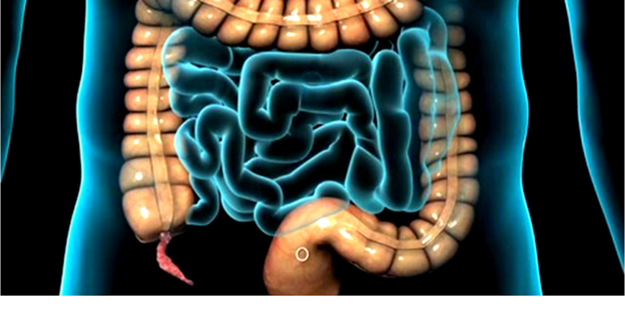 apendicitis