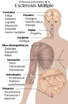 315px Symptoms of multiple sclerosis es.svg Merca2.es