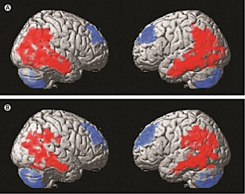 estimulacion cerebral profunda