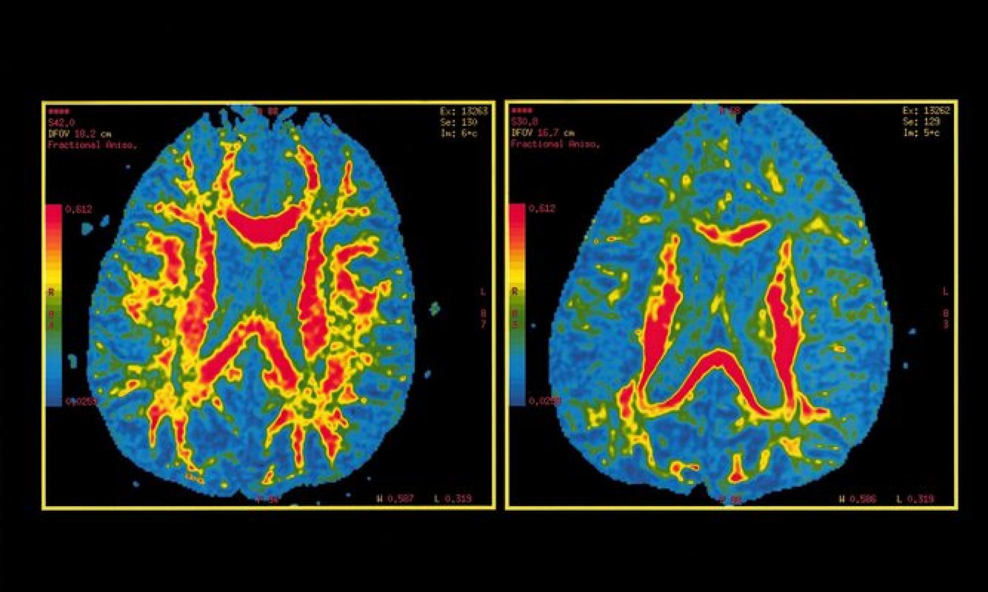 ¿Cuándo puedes contraer Alzheimer?