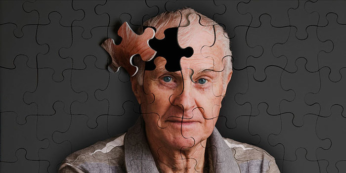 El gen PLD3 podría ser uno de los responsables del Alzheimer