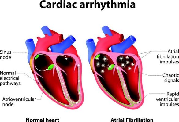 arritmia