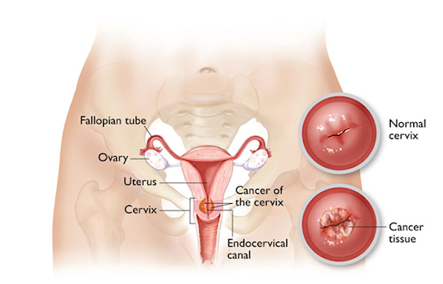 cancer cervical