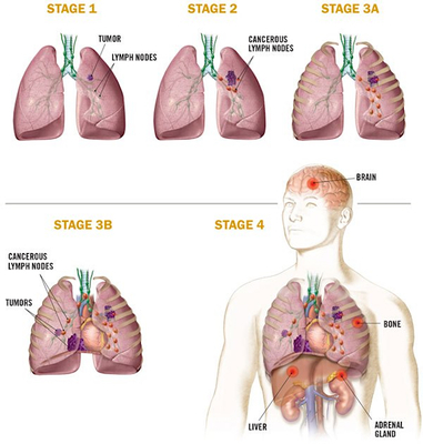 lung cancer Merca2.es