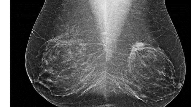 cancer breast Merca2.es
