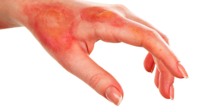 ¿Te has quemado la piel tomando el sol? Con estos consejos la volverás a tener como nueva en tiempo récord 38 Merca2.es dolores