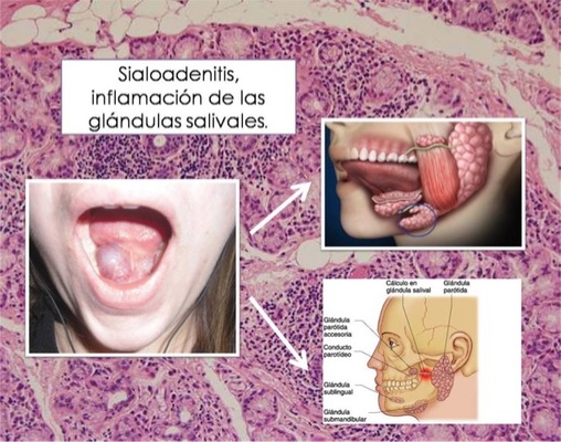 sialodenitis Merca2.es