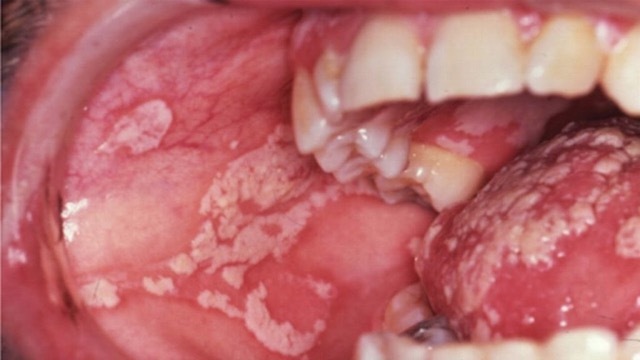 Candidiasis Merca2.es