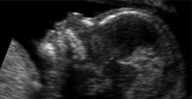 Embryo 14 weeks profile Merca2.es