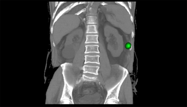 Primera intervención de cirugía abdominalradioguiada en el Ruber Juan Bravo