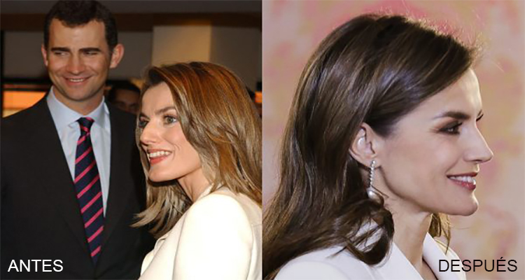 La Reina Letizia El Antes Y Después De Sus Operaciones Estéticas