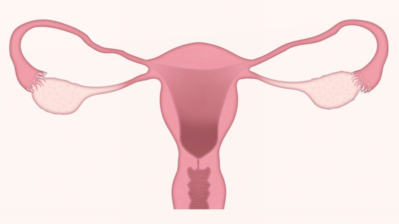 cáncer de ovarios