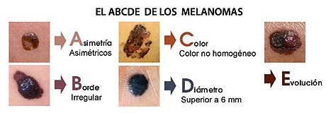 Melanoma