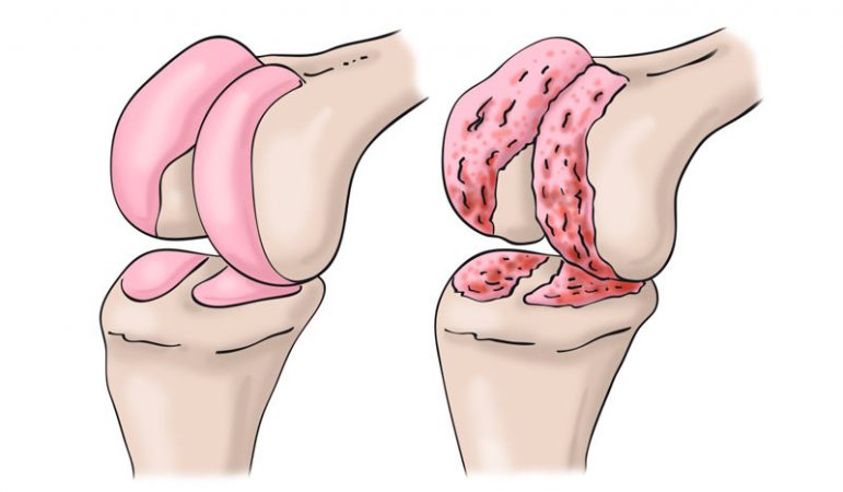 artrosis, artritis, fibromialgia