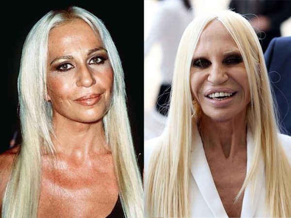 Donatella Versace, de las famosas peor operadas