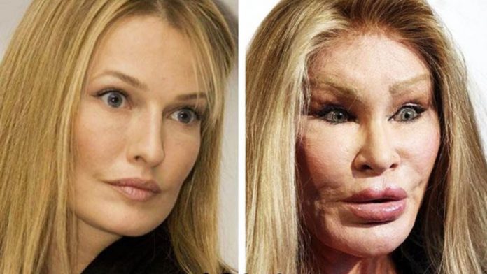 Jocelyn Wildenstein, una de las famosas peor operadas