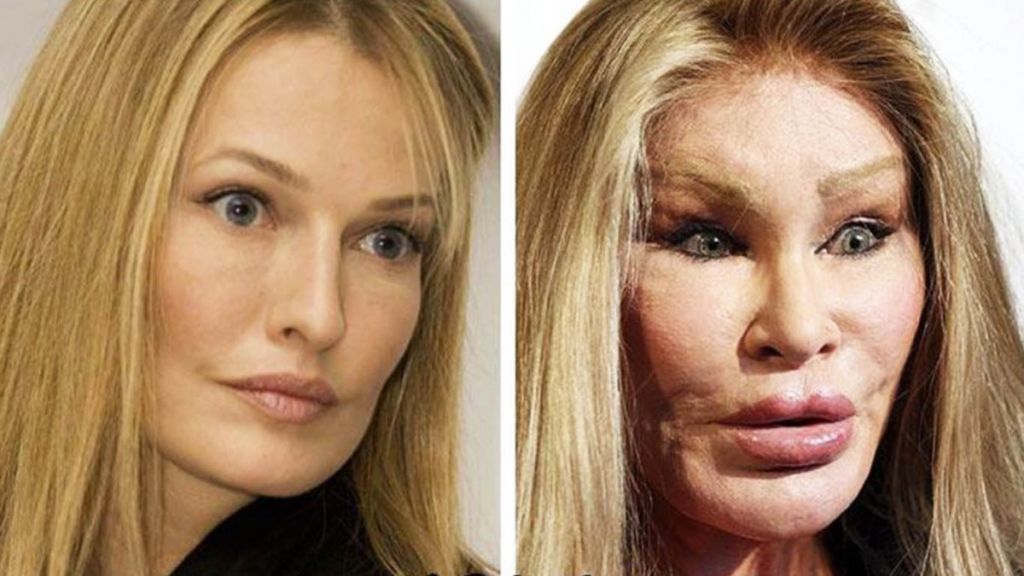 El antes y el después: las famosas peor operadas