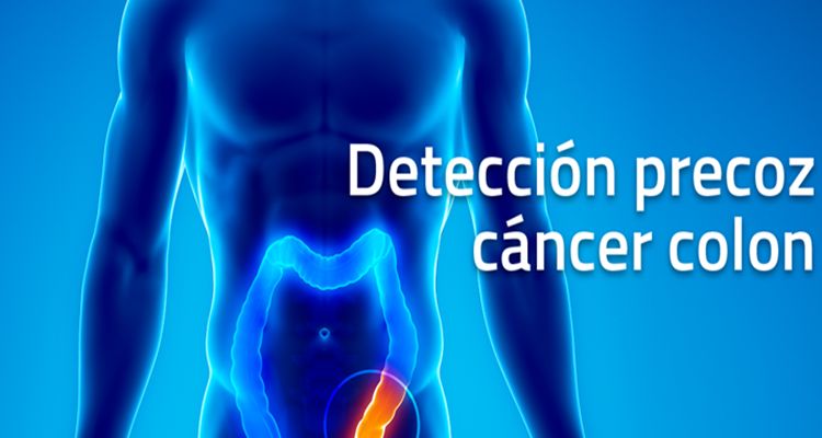 cáncer de colon origen y tratamiento