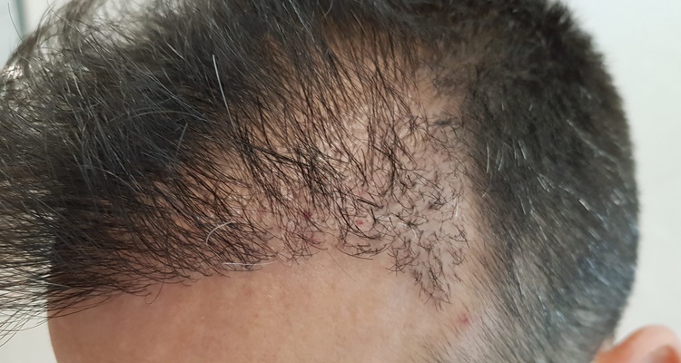 Implante capilar: cuándo, cómo y cuánto cuesta lucir un pelazo de infarto