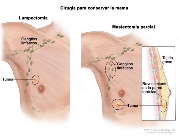 Cirugía para conservar la mama con cáncer