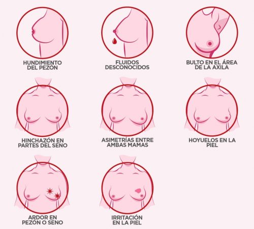 Síntomas de cáncer de mama
