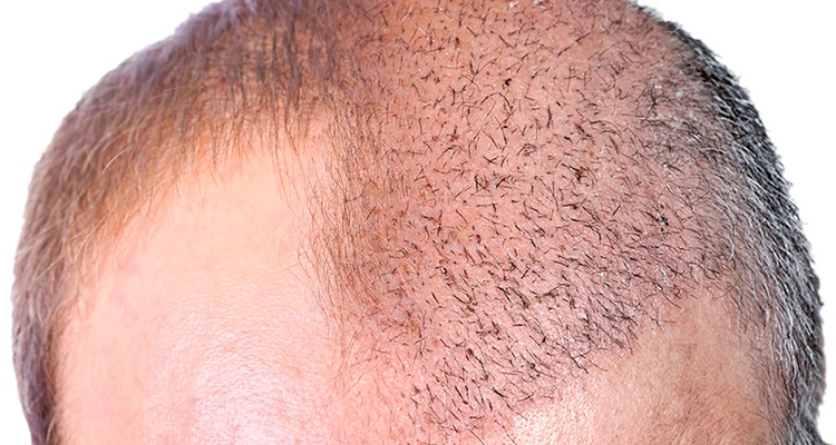 El pelo del trasplante capilar no crece Moncloa