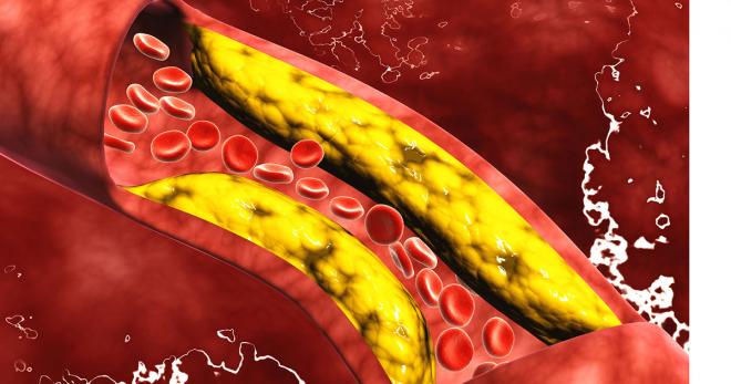 arterias obstruídas por colesterol