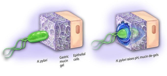 cáncer de estómago por gastritis atrófica crónica