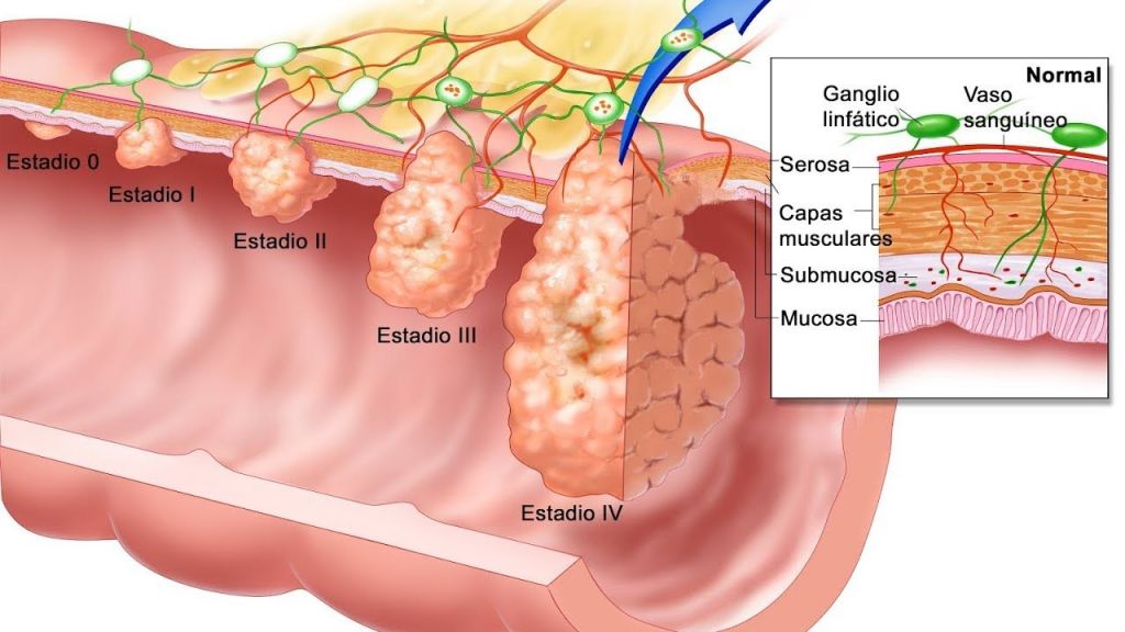 cáncer metaplasia intestinal
