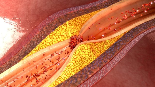 colesterol y Arterosclerosis