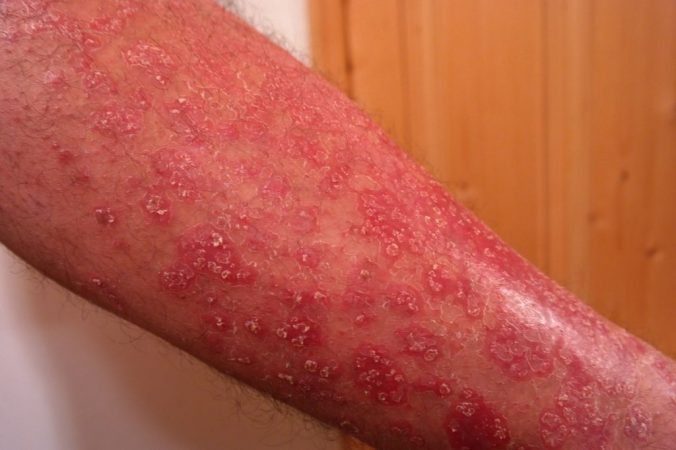 Artritis psoriásica: los problemas que tienen los enfermos como Kiko Hernández 1 Merca2.es Artritis psoriásica Kiko Hernández