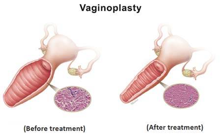 Vaginoplastia en el sexo femenino