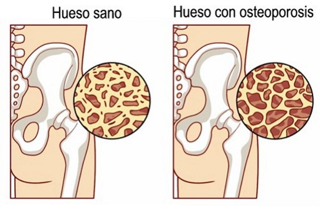 huesos con osteoporosis