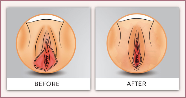 labioplastia en el sexo