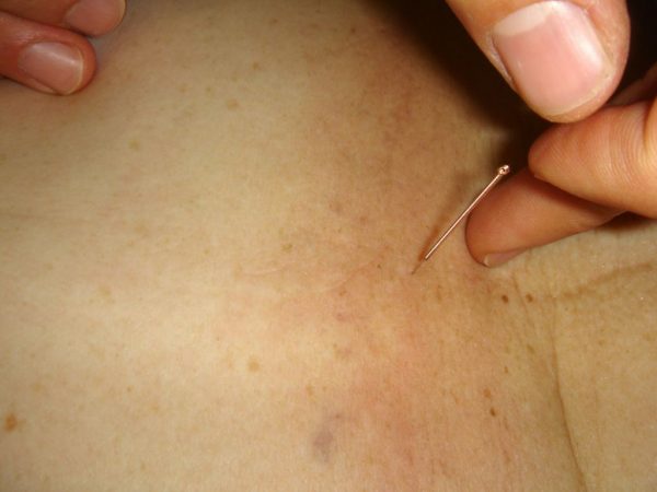 acupuntura espalda