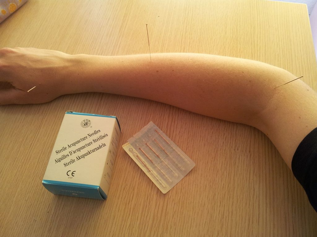 acupuntura brazo