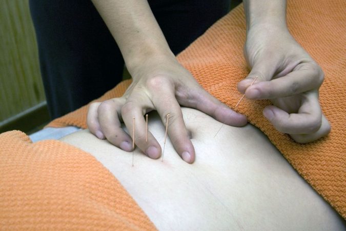 acupuntura estómago 
