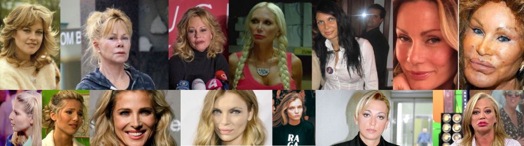 Estas famosas se han hecho cirugía en la cara (y mejor no haberlo hecho)