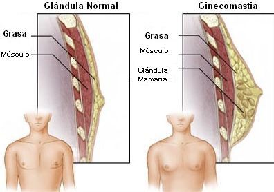 ginecomastia