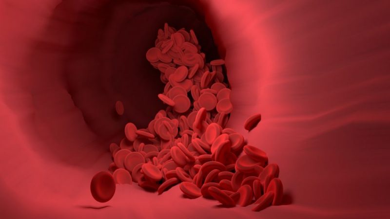 anemia ferropénica