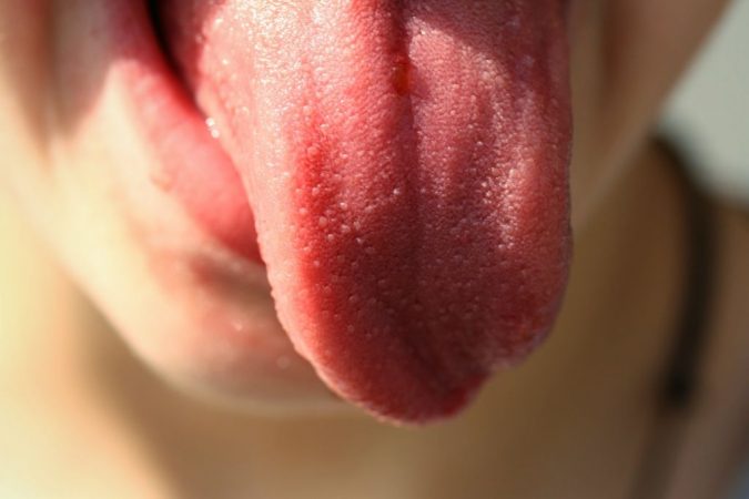 lengua y cáncer