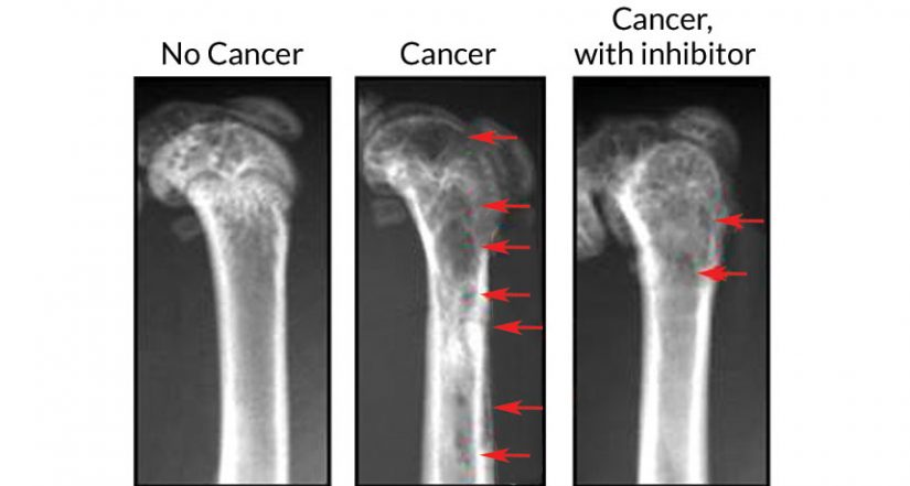 Los dolores más increíbles que puede padecer el cuerpo humano 21 Merca2.es cáncer de hueso