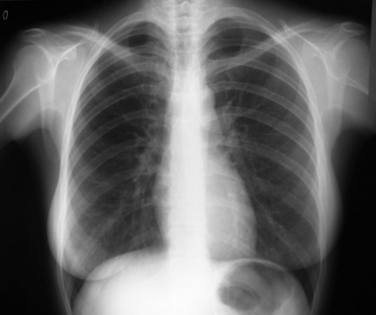 radiografía torax, salud