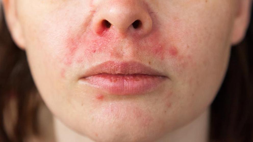 dermatitis-efectos-secundarios