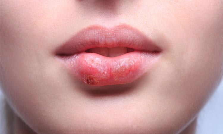 Descubre qué es el herpes labial 