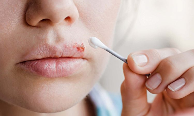 Estos son los síntomas del herpes labial