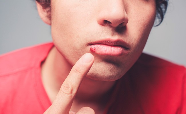 Las causas más comunes del herpes labial