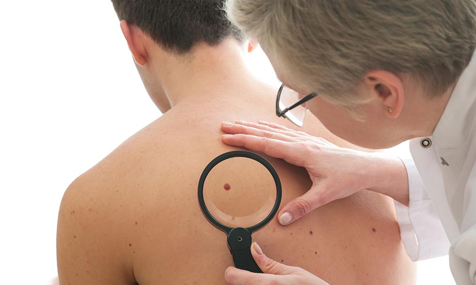 Cómo detectar a tiempo un cáncer de piel