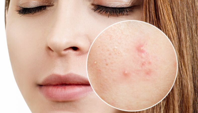 ¿Cómo se produce el acné en la piel?