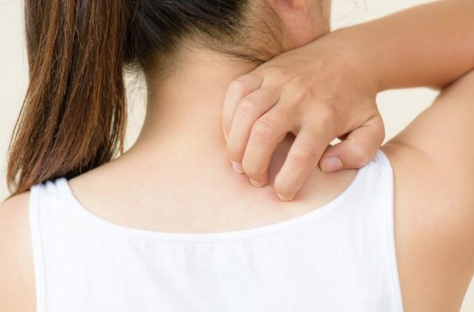 Alergia a la aspirina